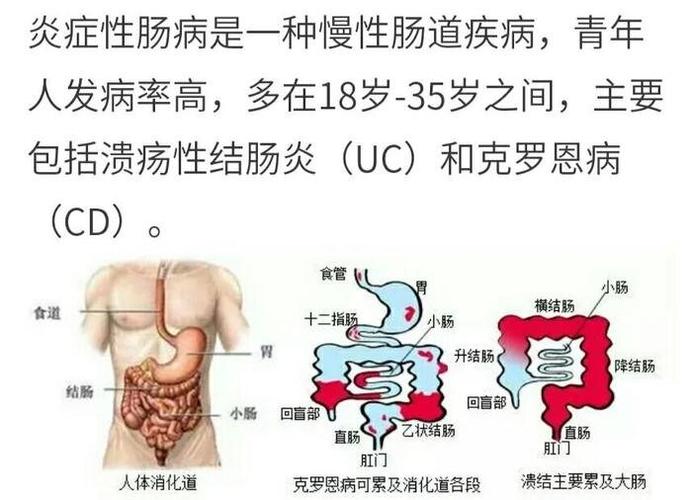 溃疡性结肠炎腹部有气