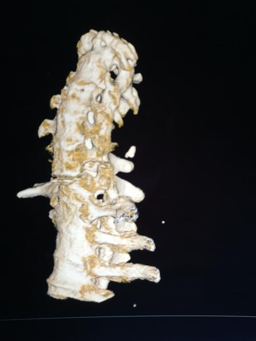 301医院强直性脊柱炎