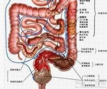 男性26岁溃疡性结肠炎