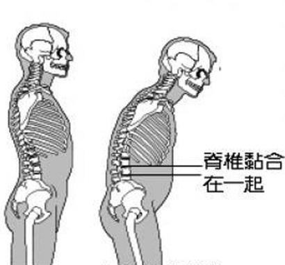 强直性脊柱炎是腰的问题吗