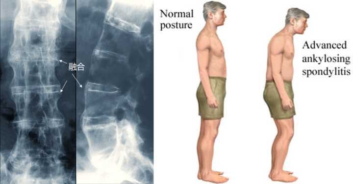 强直性脊柱炎脊椎僵直