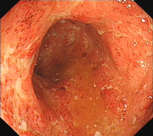 溃疡性结肠炎复查肠镜