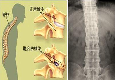 强直性脊柱炎做运动骨响