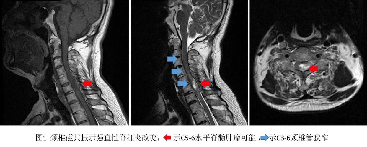 强直性脊柱炎核磁共振能拍出来吗