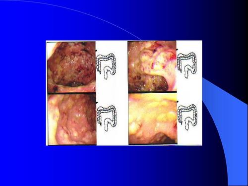 肠道充血糜烂是溃疡性结肠炎吗