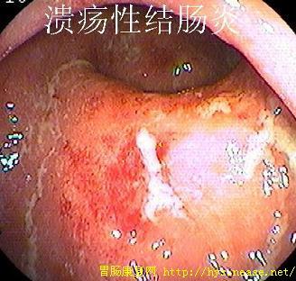 什么叫溃疡性结肠炎