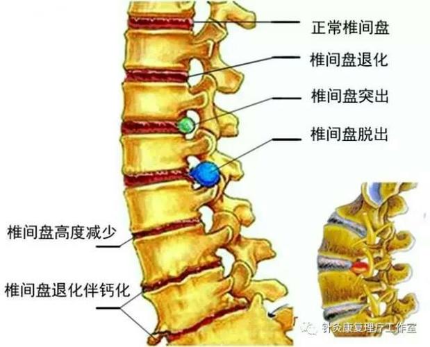 强直性脊柱炎肌腱拉伤