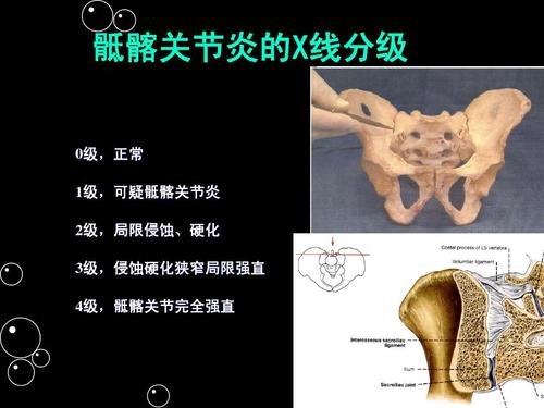 强直性脊柱炎髂骨症状