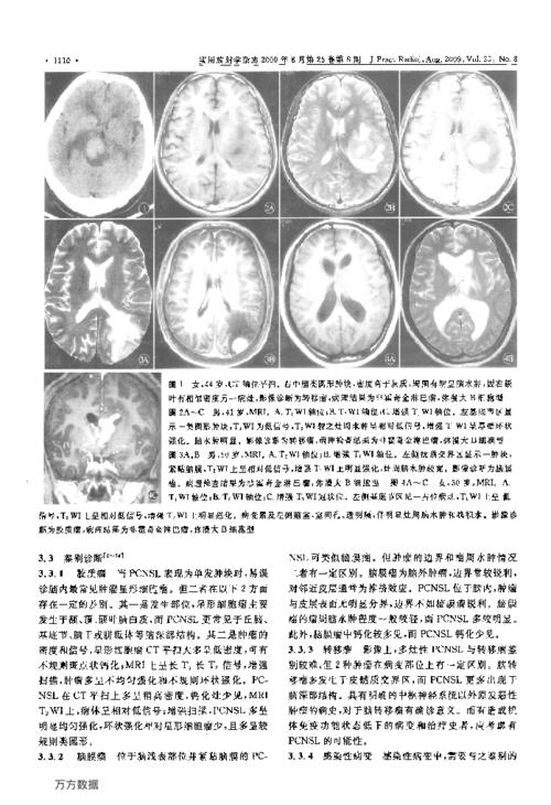 原发性中枢神经系统淋巴瘤