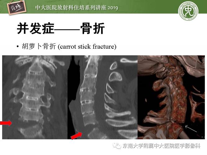 强直性脊柱炎影像片子描述