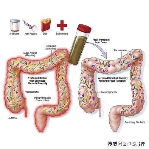 溃疡性结肠炎能用抗生素治疗吗