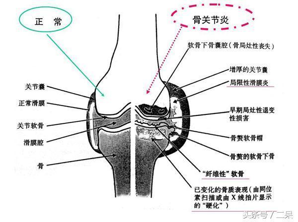 两个腿酸胀疼是强直性脊柱炎吗