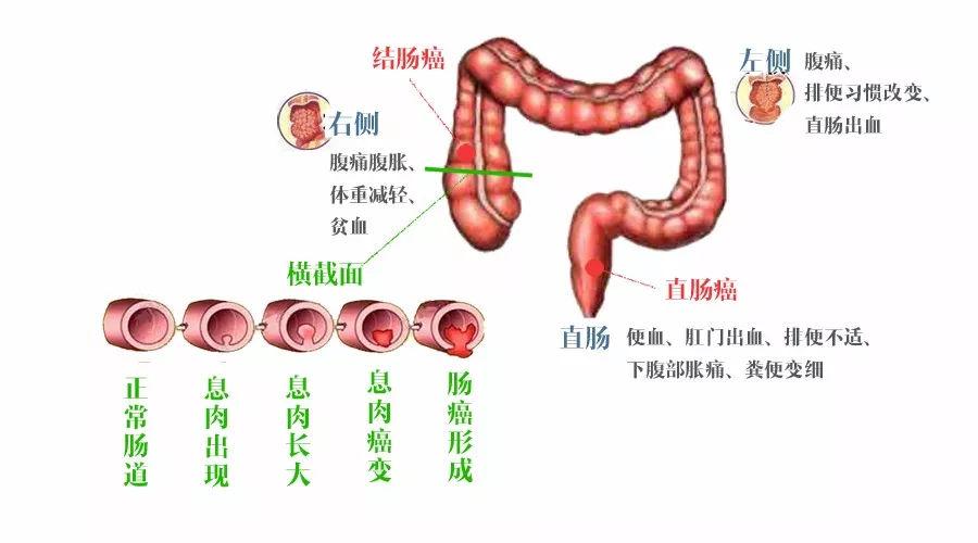 溃疡性结肠炎手术