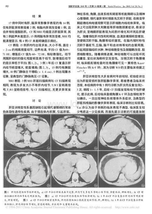 肝豆状核变性