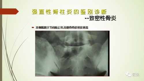 强直性脊柱炎胸腔是什么样的