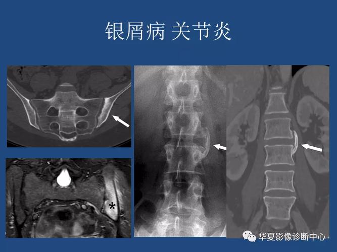 强直性脊柱炎可与哪些疾病鉴别