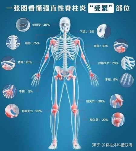 强直性脊柱炎放电