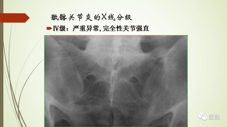 强直性脊柱炎mr影像表现