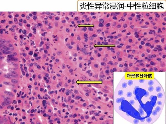 隐窝脓肿和溃疡性结肠炎