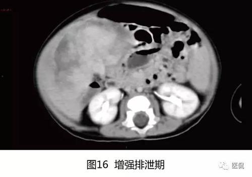 伯基特淋巴瘤