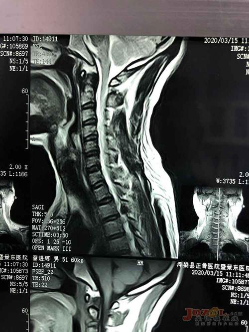 胸椎强直性脊柱炎怎样正骨