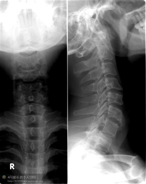 自己怎么样才能察觉强直性脊柱炎
