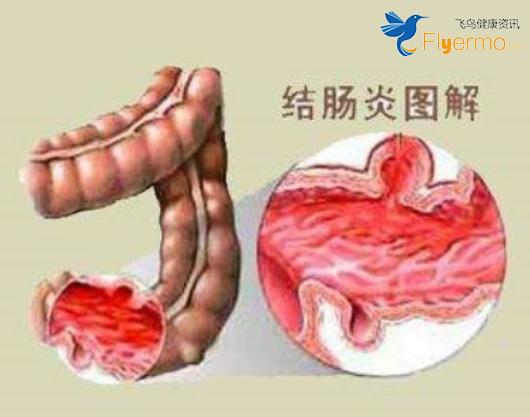 如何治疗溃疡性结肠炎