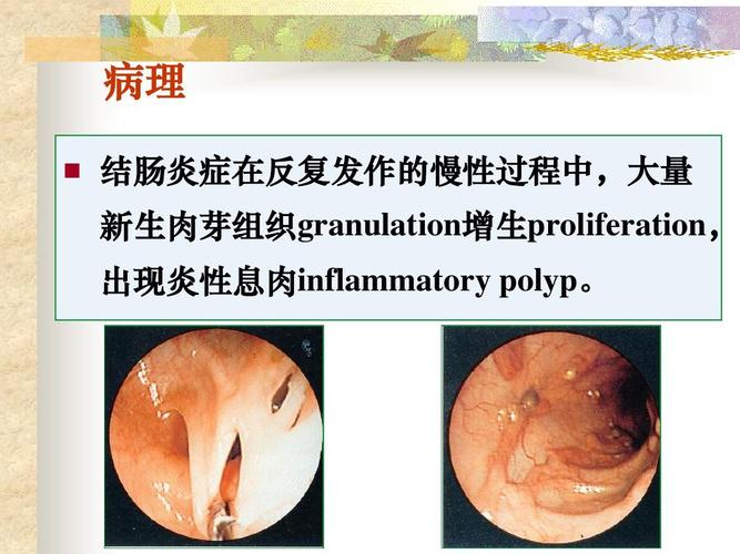 奥硝唑治溃疡性结肠炎吗