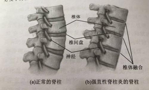 强直性脊柱炎强直了怎么恢复正常