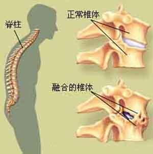 强直性脊柱炎军检能查出来吗