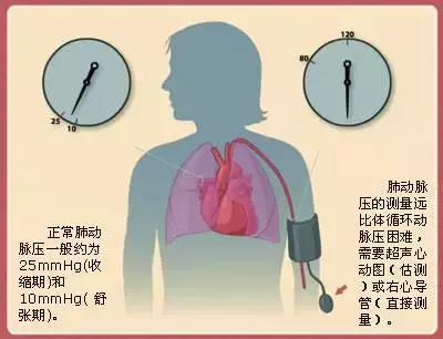 这种病被称为“心血管癌症”，有靶向药，但经常找不对医生