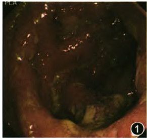 镜下溃疡性结肠炎轻中重度分级