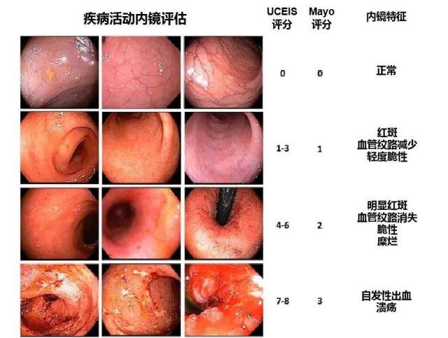 溃疡性结肠炎治疗原则