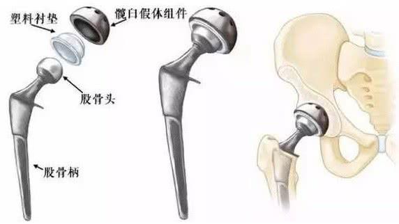 强直性脊柱炎导致股骨头置换