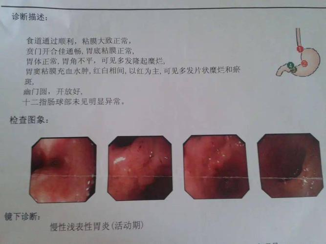 溃疡性慢性结肠炎是什么意思