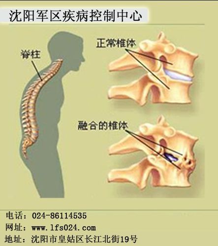 关于强直性脊柱炎描述