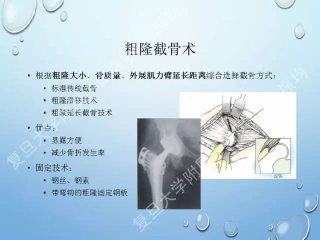 强直性脊柱炎髋关节3期