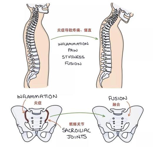 14岁男孩强直性脊柱炎能治愈吗