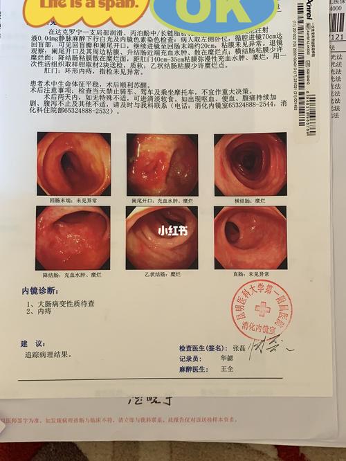 溃疡性结肠炎能吃丝瓜吗