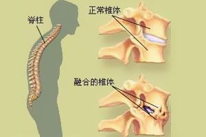 以前有过强直性脊柱炎吗