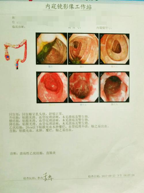 每次大便腹泻是溃疡性结肠炎吗