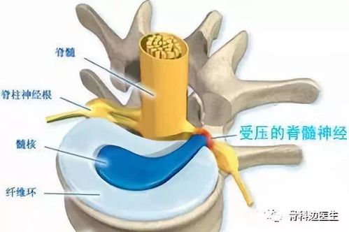 强直性脊柱炎手麻