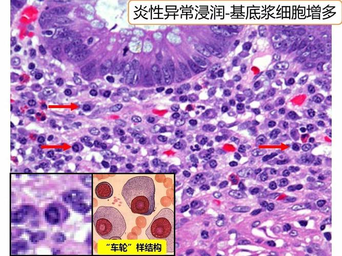 溃疡性结肠炎肠镜表现有锯齿样吗