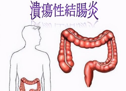 轻型溃疡性结肠炎治疗多久无症状