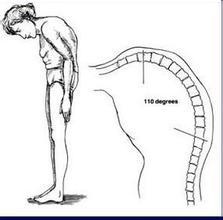 幼年强直性脊柱炎发展到成年