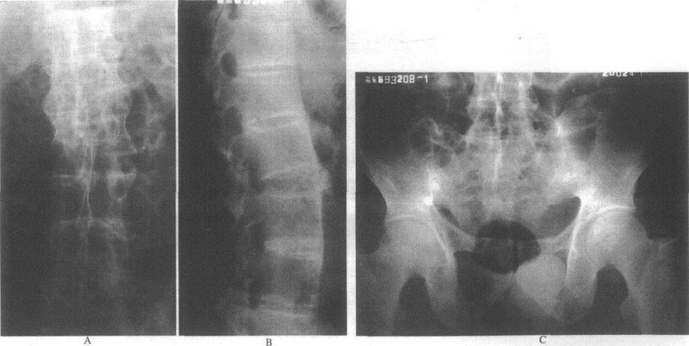 强直性脊柱炎体格检查图