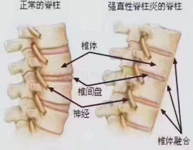 强直性脊柱炎引起的骨质增生改怎么办