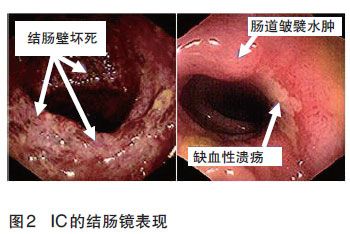 电子肠镜可以看出溃疡性结肠炎吗