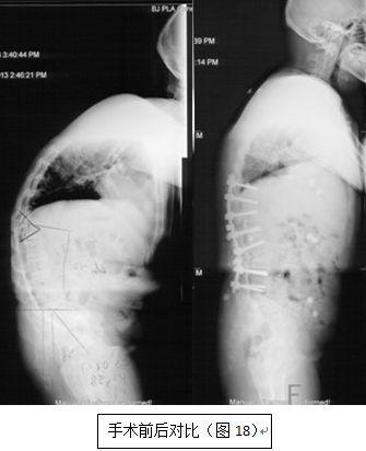 强直性脊柱炎胸椎歪了怎么办