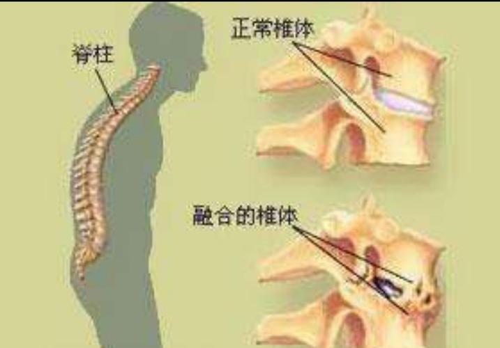 强直性脊柱炎严重吗